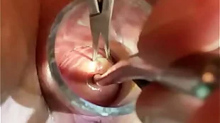 Gyno sound into uterus